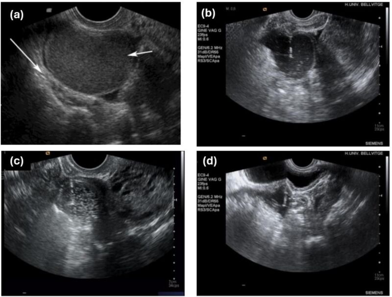 Ultrasound-guided ethanol sclerotherapy versus laparoscopic surgery for endometriomas: a randomized clinical trial in a real-world setting | Archives of Gynecology and Obstetrics | Springer Nature Link
